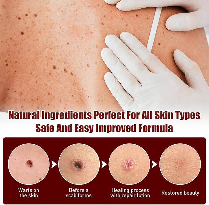 Tags and Moles Remover — product image 3