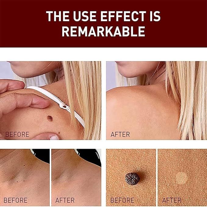 Tags and Moles Remover — product image 4